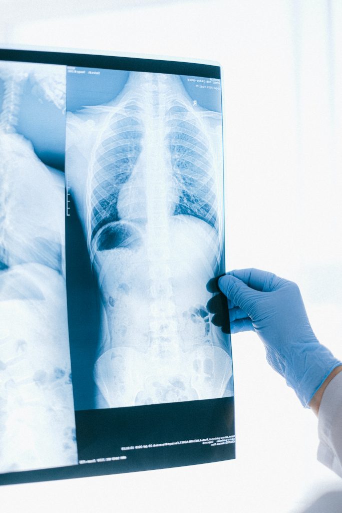 Röntgenaufnahme Oberkörper Rückenschmerzen Blog